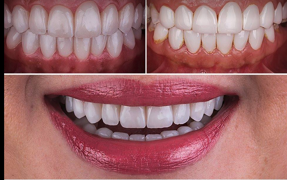 The Original Snap On Smile Veneers. - ZefTe