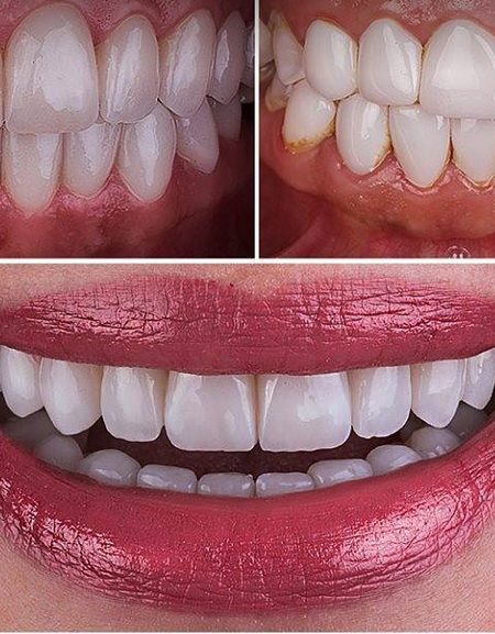 The Original Snap On Smile Veneers. - ZefTe