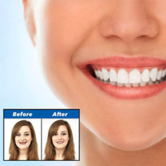Best  Snap-On Smile Amazing Perfect & Confident Smile Clip-On  Veneers. - ZefTe