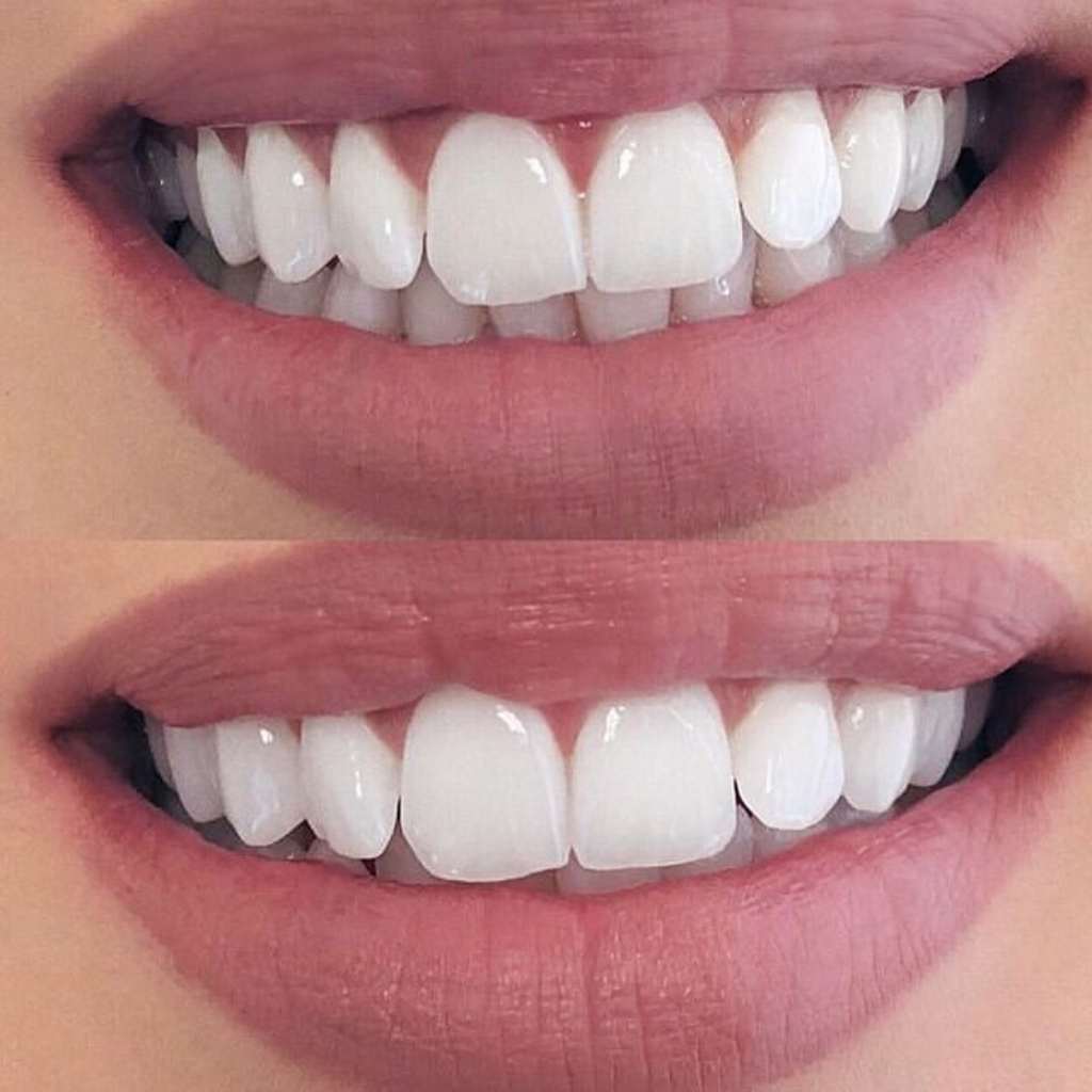 Snap On Smile Veneers Top & Bottom