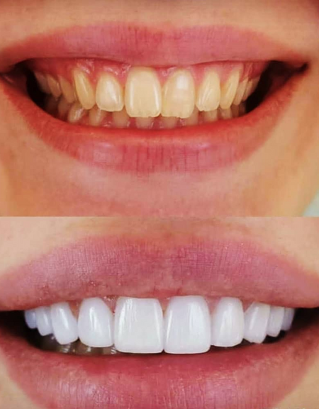Elegant & Effortless Snap-On Veneers